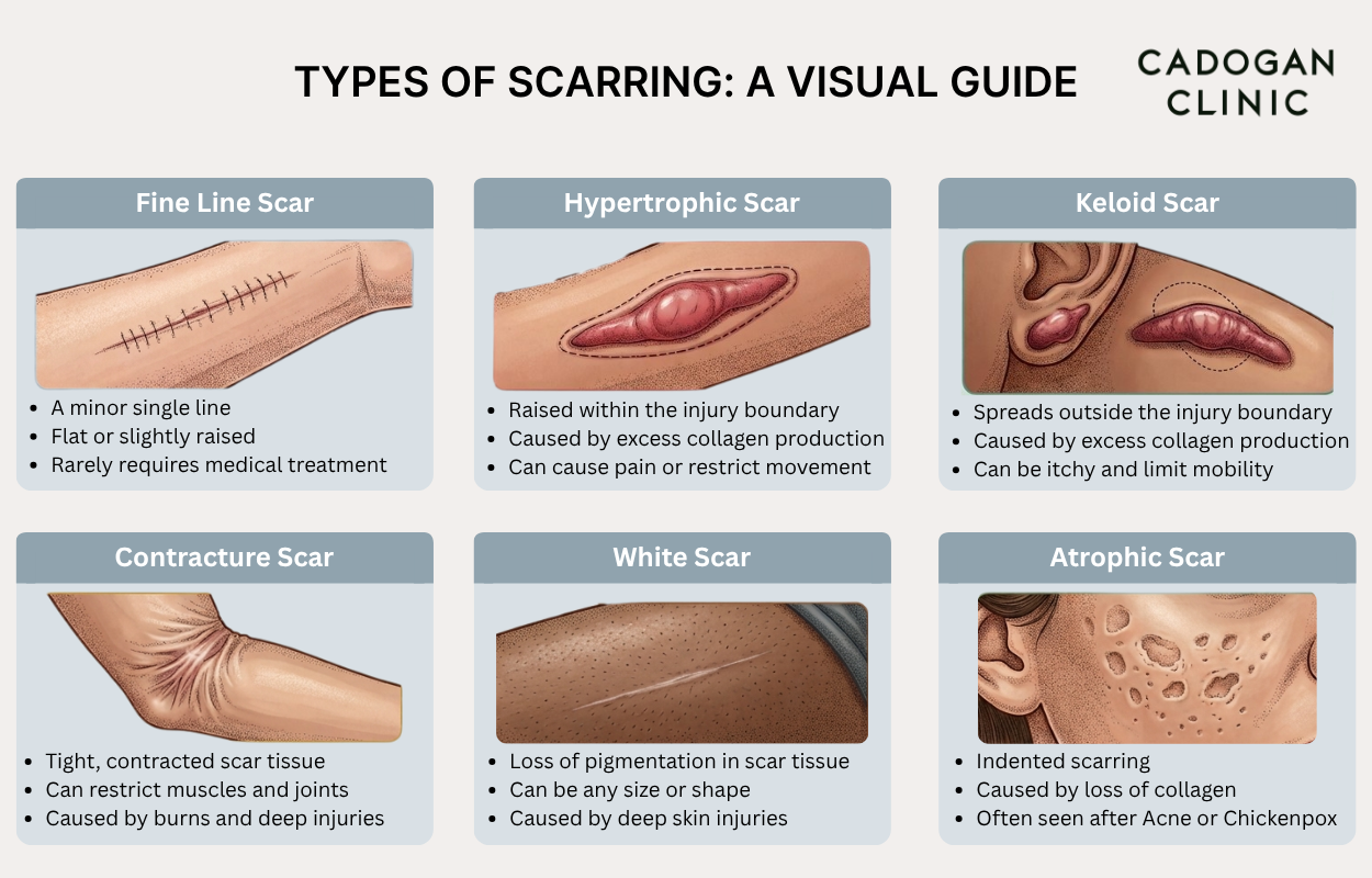 An infographic showing the appearance of fine line, hypertophic, keloid, contracture, white and atrophic scarring